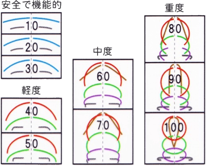 巻き爪の湾曲度合いを角度で示した図（軽度・中度・重度）