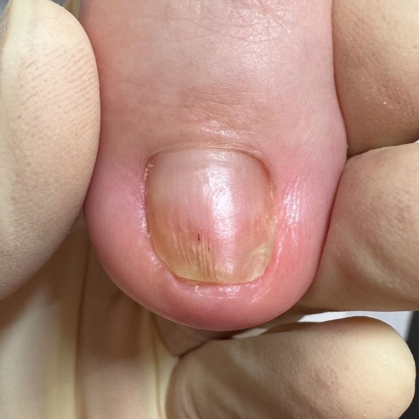巻き爪補正後の足の爪