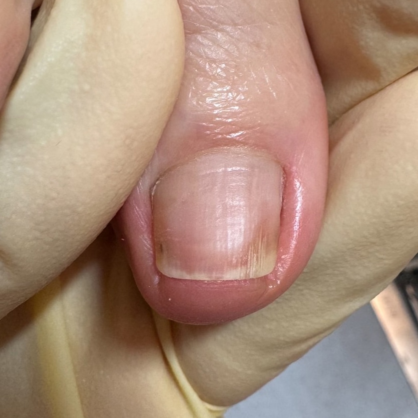 巻き爪補正後の足の爪