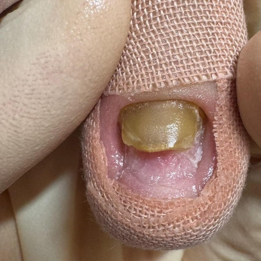 巻き爪補正後の足の爪