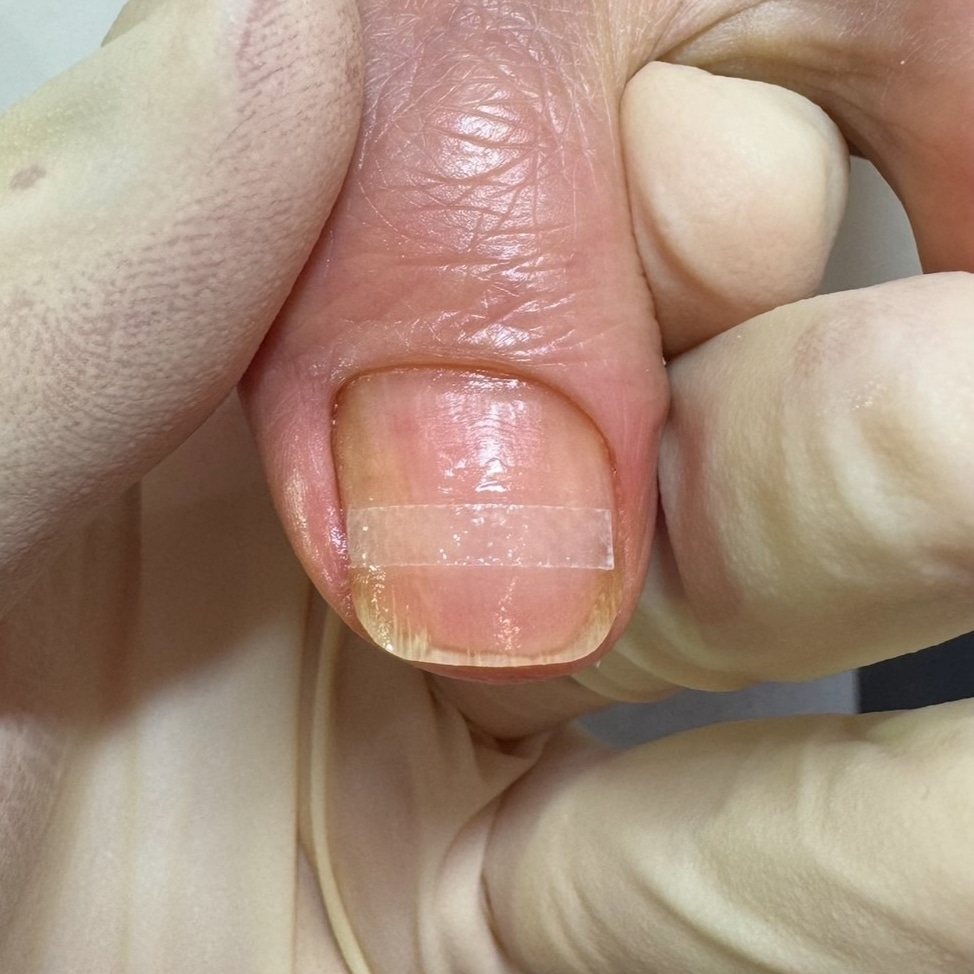 巻き爪補正後の足の爪