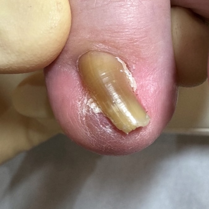 巻き爪補正前の足の爪