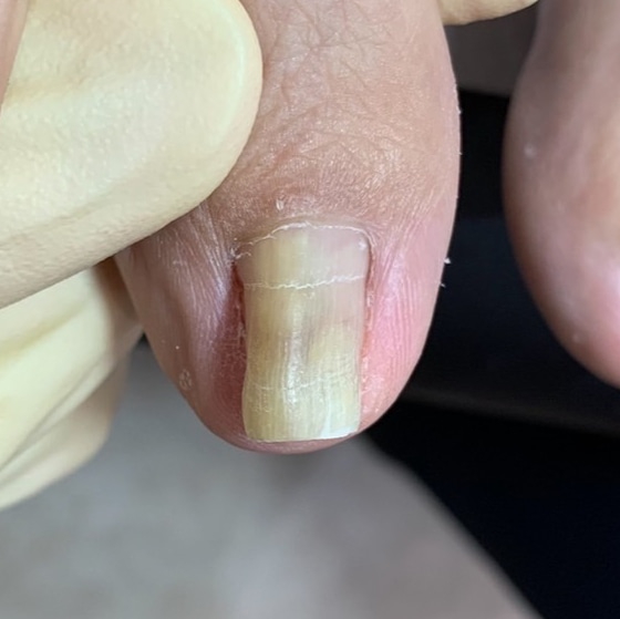 巻き爪補正前の足の爪