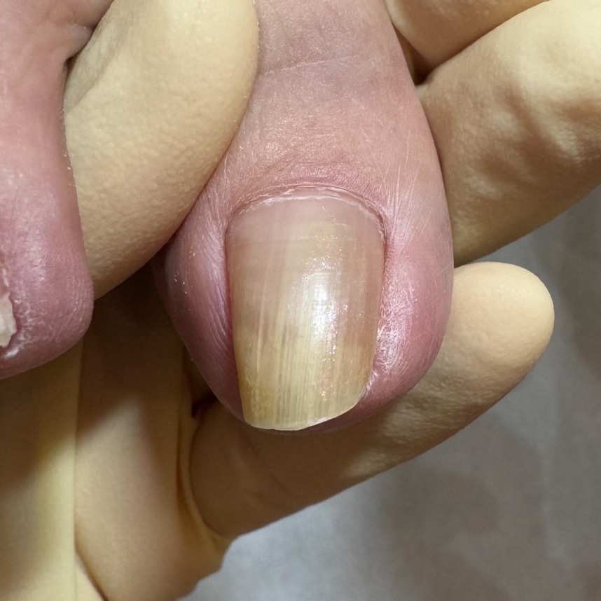 巻き爪補正前の足の爪