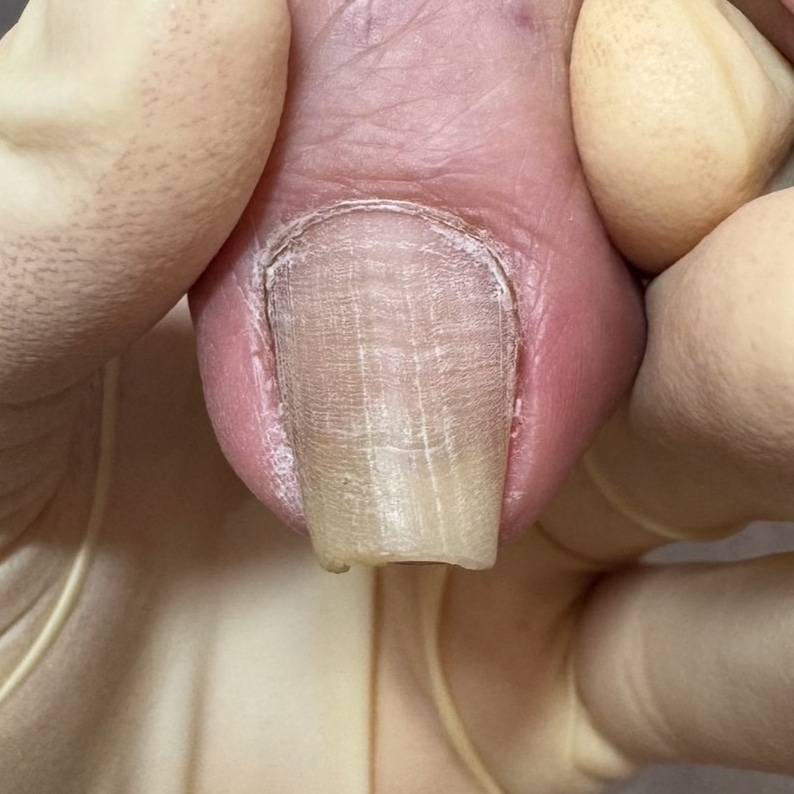 巻き爪補正前の足の爪
