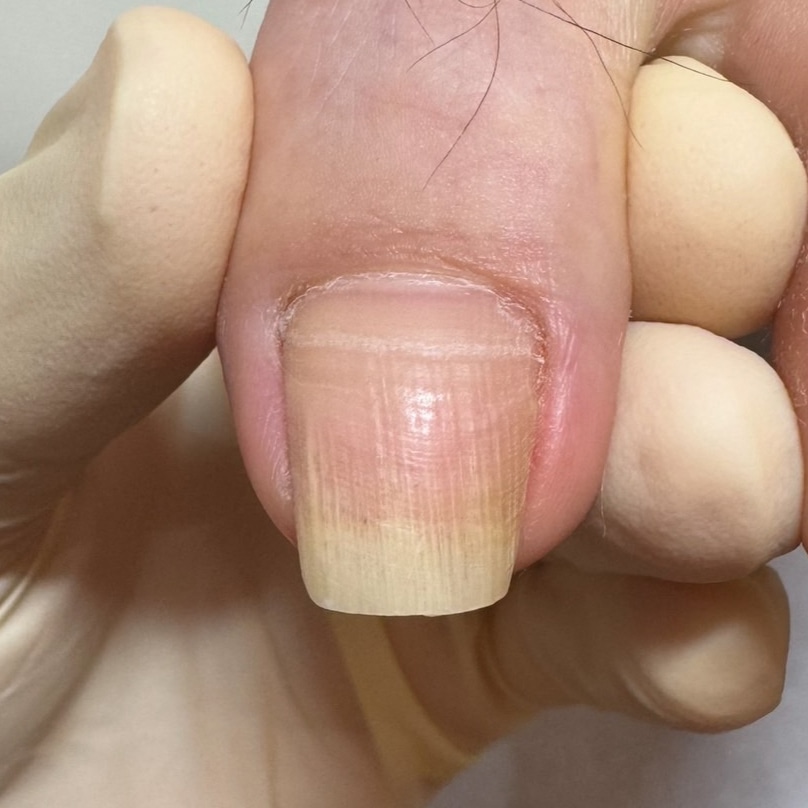巻き爪補正前の足の爪