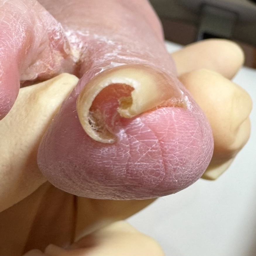 巻き爪補正前の足の爪