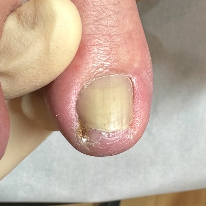 巻き爪補正前の足の爪