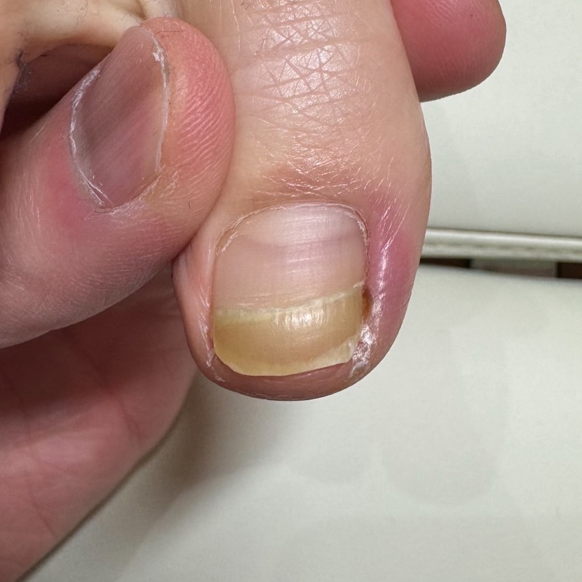 巻き爪補正前の足の爪