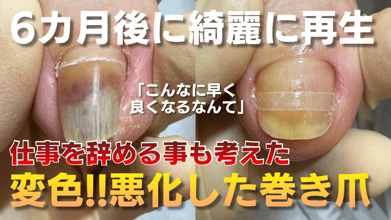 変色して悪化した巻き爪と、6カ月の補正後に綺麗に再生した爪を並べた比較写真